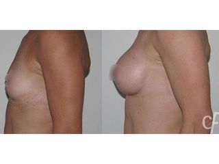 Antes y después Aumento de pecho