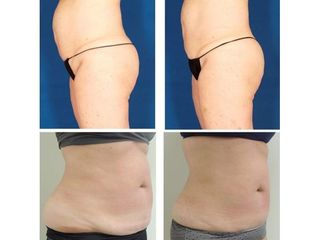 Antes y después Criolipolisis