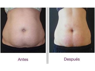 Antes y después Criolipolisis 