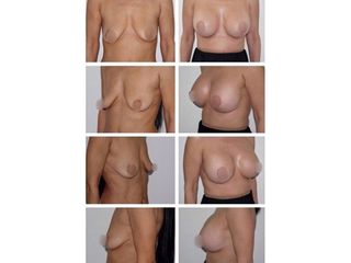 Antes y después Mastopexia