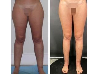 Antes y después Liposucción