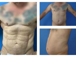 Antes y después Marcación Abdominal 