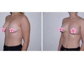 Antes y después Mastopexia 