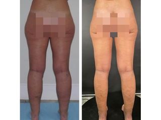 Antes y después Liposucción 