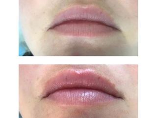 Antes y después Aumento de labios 