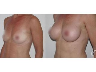 Antes y después Aumento de pecho 