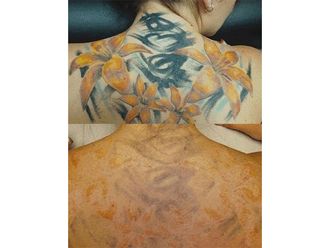 Eliminación de tatuajes - 684748