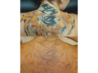 Antes y después Eliminación tatuaje