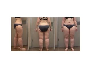 Antes y después Lipedema - Clínica Fontana