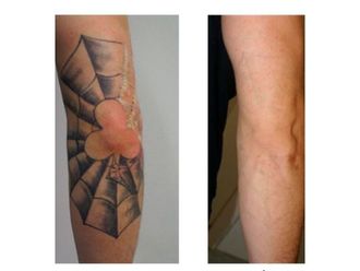 Eliminación de tatuajes - 701753