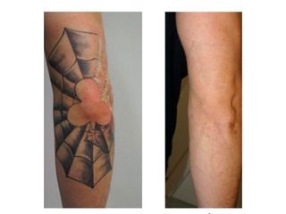 Antes y después Eliminación de tatuajes