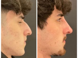 Rinomodelación antes y después - 877187