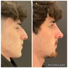 Rinomodelación - Clinica Dra. Margelis Cruces