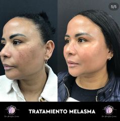 Clinica Dra. Margelis Cruces - Melasma