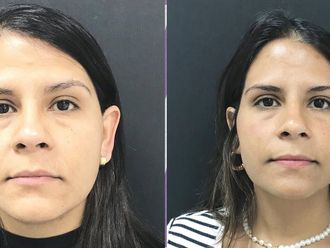 Rejuvenecimiento facial antes y después - 877189
