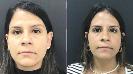 Clinica Dra. Margelis Cruces - Rejuvenecimiento