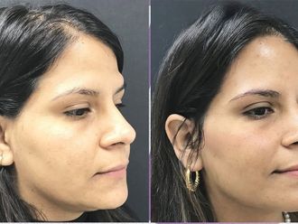 Rejuvenecimiento facial antes y después - 877190