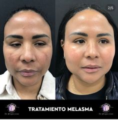 Clinica Dra. Margelis Cruces - Melasma