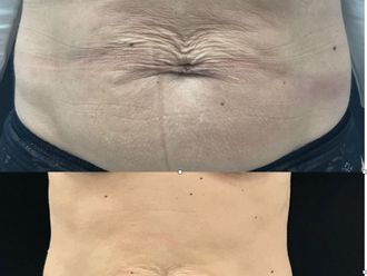 Celulitis antes y después - 877305