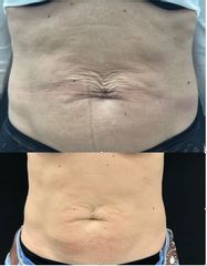 Clinica Dra. Margelis Cruces - Mejor de la flacidez del abdomen