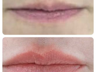 Aumento labios antes y después - 879747