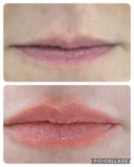 Aumento de labios