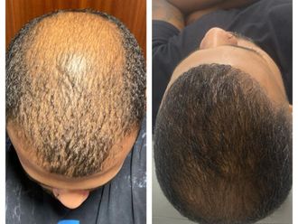 Alopecia antes y después - 879769