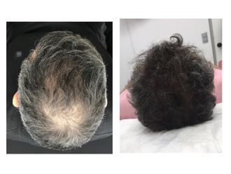 Alopecia antes y después - 879770