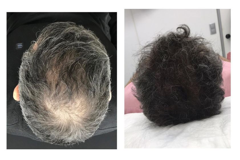 Alopecia antes y después - 879770