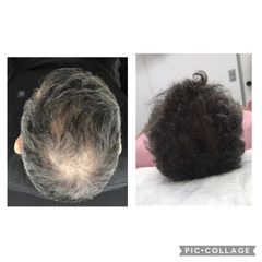 Clinica Dra. Margelis Cruces - Alopecia
