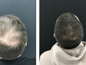 Alopecia antes y después - 879771