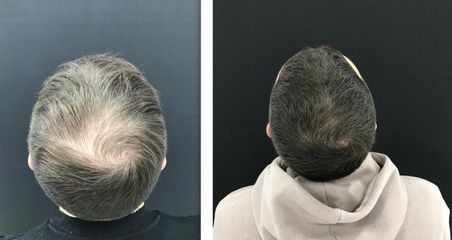 Clinica Dra. Margelis Cruces - Alopecia