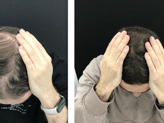 Alopecia antes y después - 879772