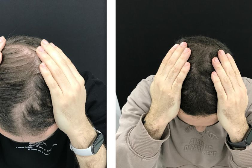 Alopecia antes y después - 879772