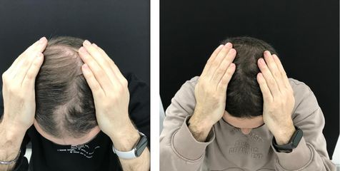 Clinica Dra. Margelis Cruces - Alopecia