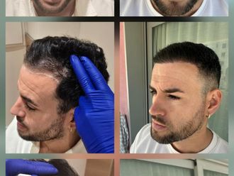 Alopecia antes y después - 879773
