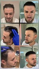 Clinica Dra. Margelis Cruces - Alopecia