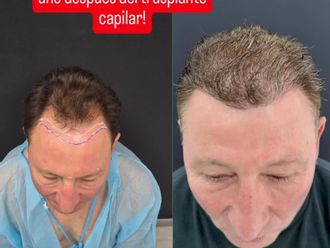 Trasplantes capilares antes y después - 879774