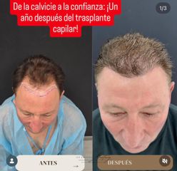 Clinica Dra. Margelis Cruces - Alopecia