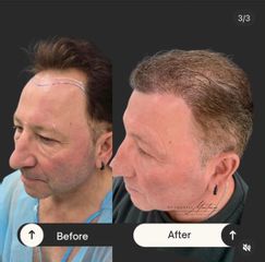 Clinica Dra. Margelis Cruces - Alopecia