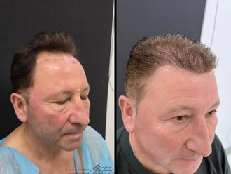 Alopecia antes y después - 879776
