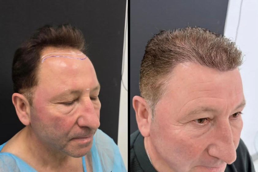 Alopecia antes y después - 879776