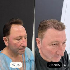 Clinica Dra. Margelis Cruces - Alopecia