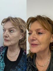 Clinica Dra. Margelis Cruces - Eliminación de arrugas
