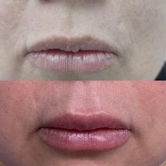 Clinica Dra. Margelis Cruces - Aumento de labios
