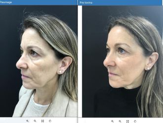 Blefaroplastia sin cirugía antes y después - 879782