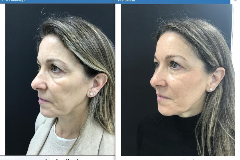 Blefaroplastia sin cirugía antes y después - 879782
