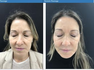 Blefaroplastia sin cirugía antes y después - 879783