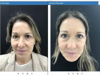 Blefaroplastia sin cirugía antes y después - 879784