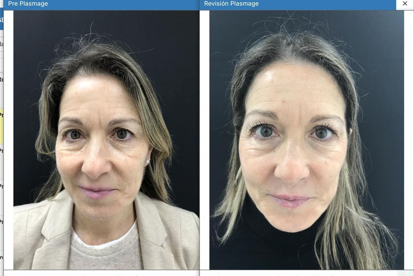 Blefaroplastia sin cirugía antes y después - 879784